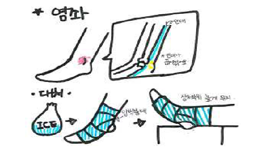 [체육] 스포츠 안전사고에 따른 응급처치 이해하기